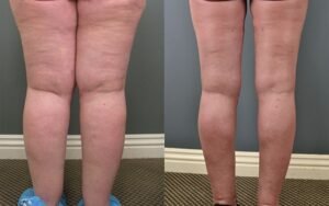 lipedema-antes-e-depois19.jpg